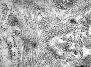 M,42y. | mild endocardial fibrosis - left ventricle (crossing of myofibrils,perhaps artifactual) M,42y. | mild endocardial fibrosis - left ventricle (crossing of myofibrils,perhaps artifactual)